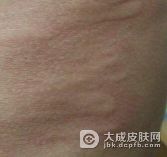 对抗皮肤过敏的方法有哪些