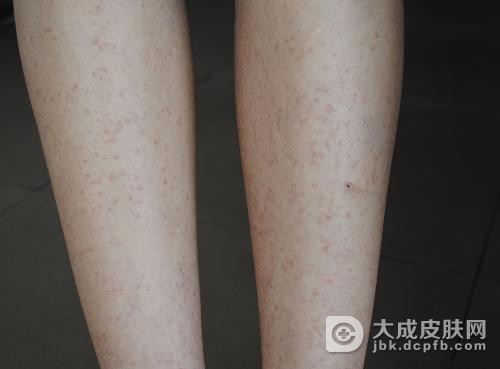 传染性红斑的预防措施都有哪些