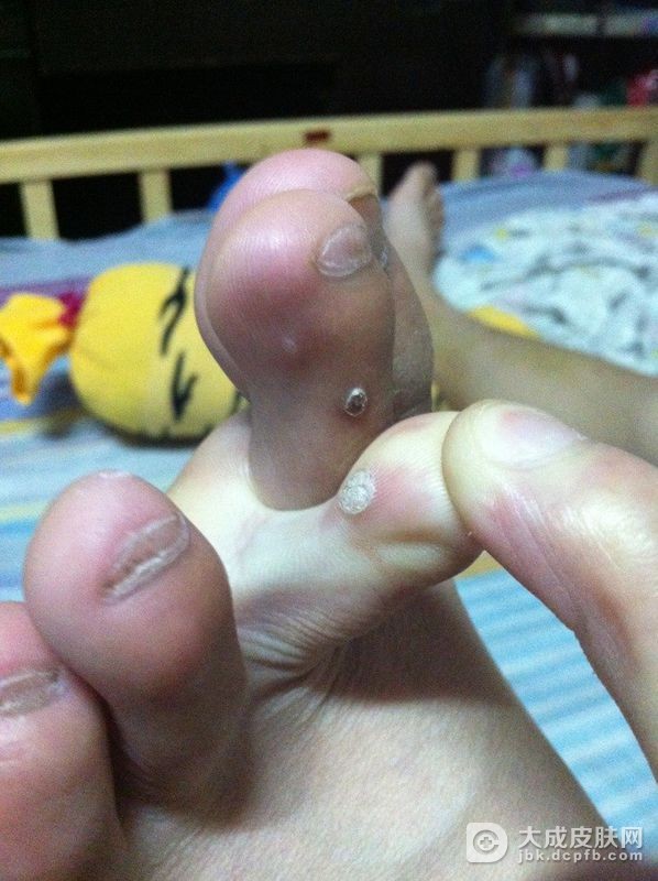 出现瘊子后的饮食调理方法是什么