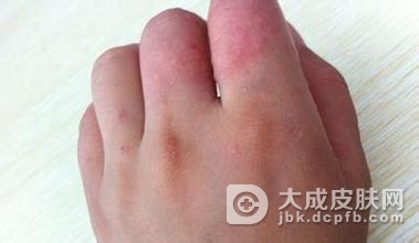 汗疱疹需要怎样的预防呢
