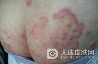 关节病型银屑病症状