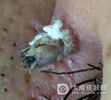 病毒疣早期治疗效果好