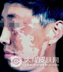 白癜风治疗注意事项