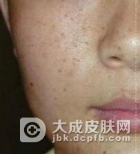 皮肤黑变病的判断依据及根源