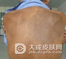 中医对于黑变病的根本认识及患者须知