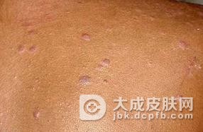 扁平苔藓的主要的症状都有什么？