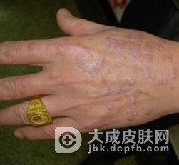 扁平苔藓到底该怎么的治疗