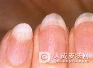 趾断症是什么的原因诱发的