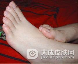趾断症的病因到底是什么