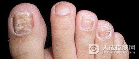 趾断症是由什么样的原因引发的