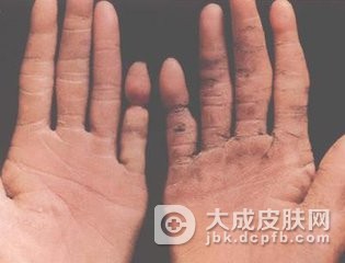 趾断症应该要怎样的处理