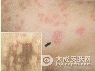 肠病性肢端皮炎有什么表现吗