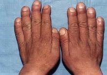 肠病性肢端皮炎有哪些的主要症状