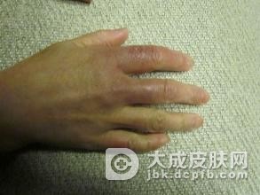 预防冻疮的好方法都有什么呢