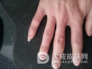 对于小儿冻疮要如何进行护理呢