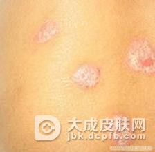 结节性痒疹的病发会有什么损害