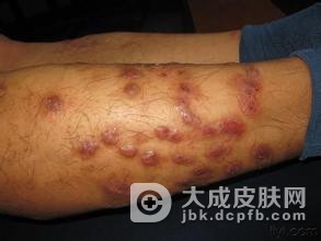 结节性痒疹要及时进行治疗