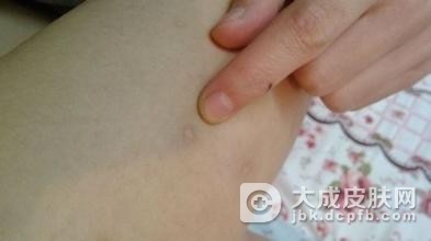 结节性痒疹经常见的症状