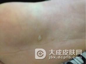寻常疣常见的一些治疗偏方有哪些