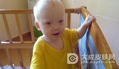 白化病的复发原因有什么呢