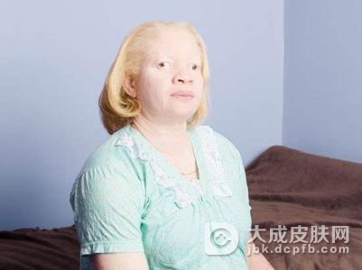 白化病患者的日常饮食怎么注意