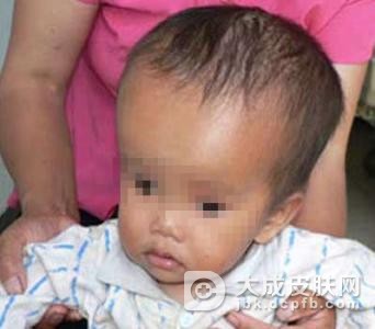 成人硬肿症如何治愈呢