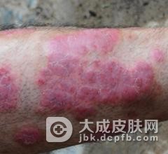 气候也是银屑病的诱因