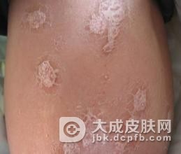 银屑病到底会不会出现遗传现象