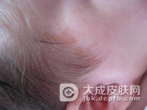 眼部红胎记有哪些危害