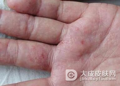 手癣与汗疱疹怎样进行区别呢