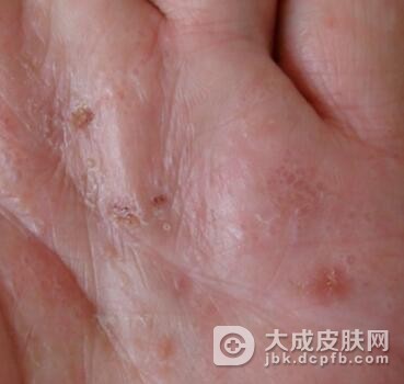 汗疱疹的保健措施是什么呢