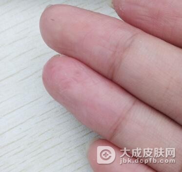手癣有何症状表现