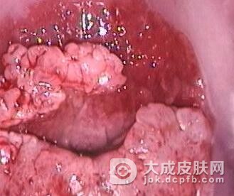 女性尖锐湿疣患者都有哪些危害