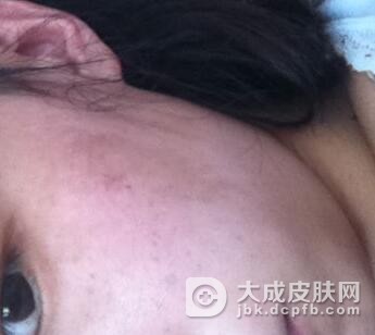 咖啡斑有哪些临床症状