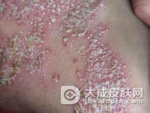 单纯性痒疹的护理方法有哪些