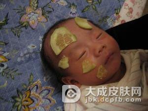 婴儿长痱子应该怎么办才好