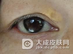 怎么确诊黄瘤病呢