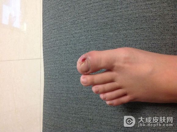 为什么会得甲沟炎