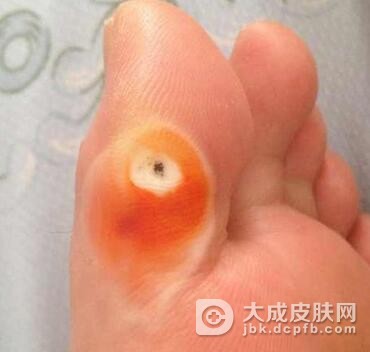 治疗鸡眼的五种辅助方法是什么