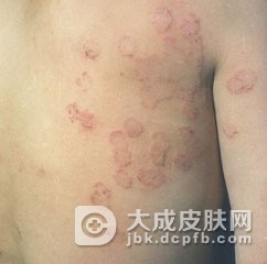 体癣怎样治恢复的快