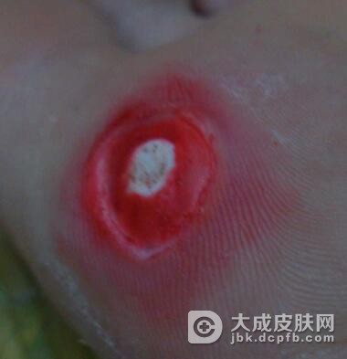 鸡眼可以用手术治愈吗
