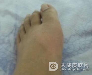 痈是一种怎样的疾病
