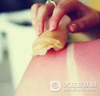 炎热的夏季怎样预防日光性皮炎