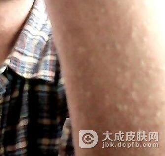 副银屑病痒吗