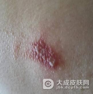 痈的发病机制有哪些呢