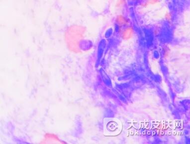 男性患了尖锐湿疣潜伏期是多久