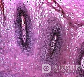 你知道尖锐湿疣是如何传染的吗