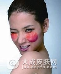 红血丝的饮食注意些什么