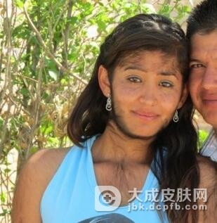 女性多毛症的治疗方法