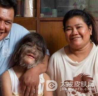 多毛症与哪些疾病有关